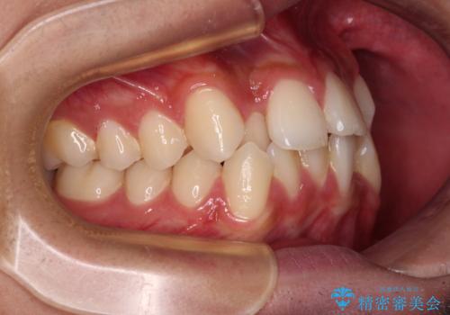 【モニター】デコボコ前歯をワイヤー装置での抜歯矯正で改善の治療前