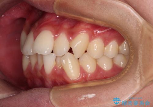 【モニター】デコボコ前歯をワイヤー装置での抜歯矯正で改善の治療前