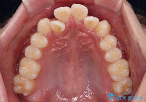 【モニター】デコボコ前歯をワイヤー装置での抜歯矯正で改善の治療前