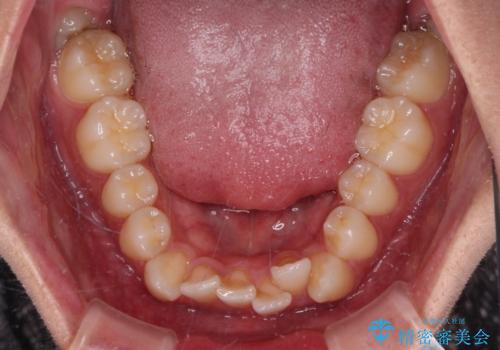 【モニター】デコボコ前歯をワイヤー装置での抜歯矯正で改善の治療前