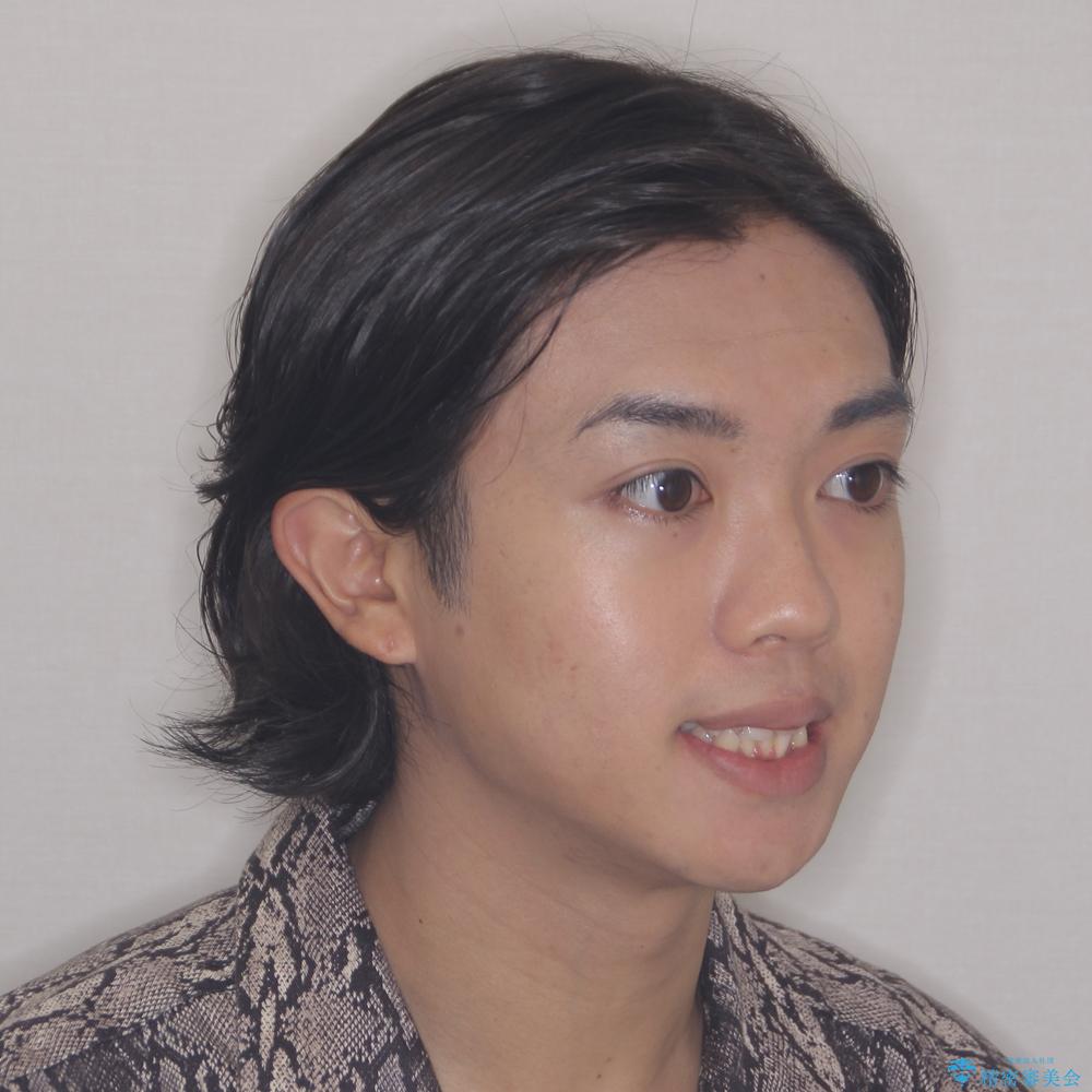 【モニター】デコボコ前歯をワイヤー装置での抜歯矯正で改善の治療前(顔貌)