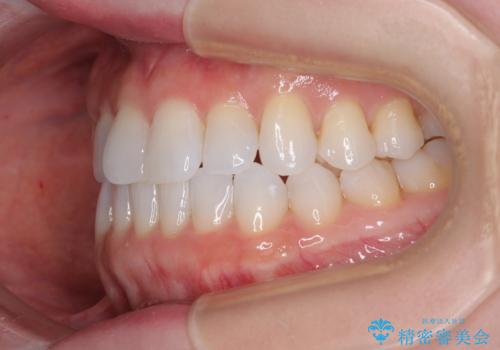 前歯のデコボコをインビザラインで綺麗にの治療後