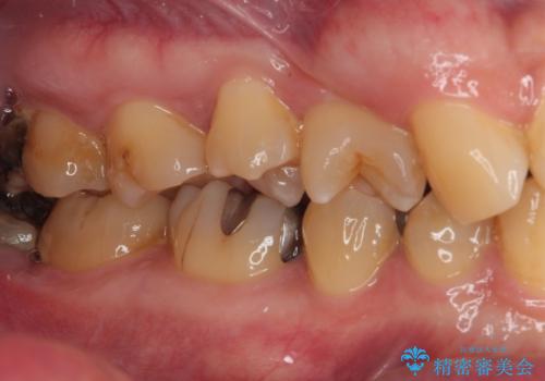 金属の詰め物がとれたので虫歯治療をしたい セラミックインレー修復の治療後