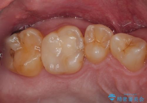 金属の詰め物がとれたので虫歯治療をしたい セラミックインレー修復の症例 治療後