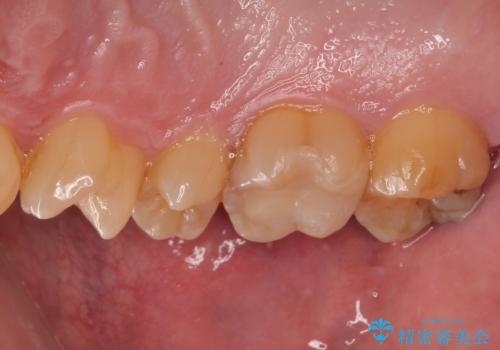 金属の詰め物がとれたので虫歯治療をしたい セラミックインレー修復の治療後