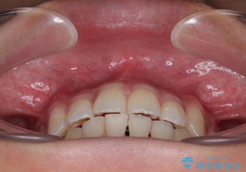 【モニター】デコボコ前歯をワイヤー装置での抜歯矯正で改善の治療後