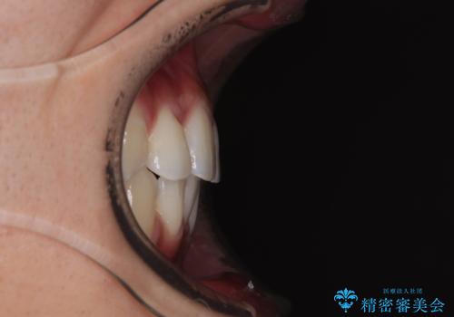 【モニター】デコボコ前歯をワイヤー装置での抜歯矯正で改善の治療後