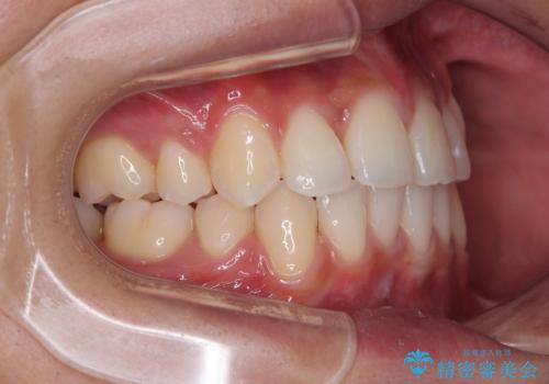 【モニター】デコボコ前歯をワイヤー装置での抜歯矯正で改善の治療後