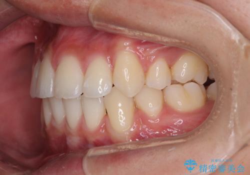 【モニター】デコボコ前歯をワイヤー装置での抜歯矯正で改善の治療後