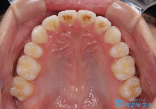【モニター】デコボコ前歯をワイヤー装置での抜歯矯正で改善の治療後