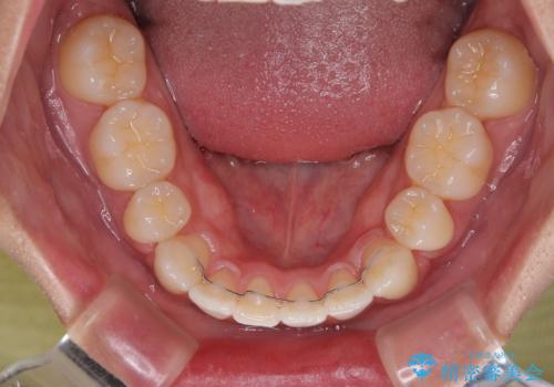 【モニター】デコボコ前歯をワイヤー装置での抜歯矯正で改善の治療後