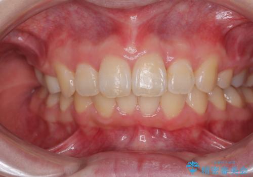 飛び出した前歯 抜歯矯正で横顔が劇的変化の治療後