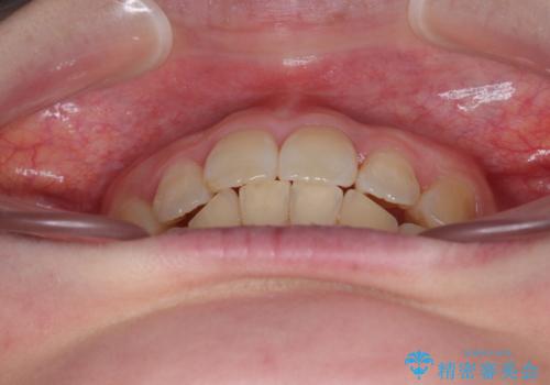 飛び出した前歯 抜歯矯正で横顔が劇的変化の治療後