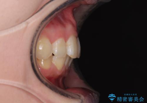 飛び出した前歯 抜歯矯正で横顔が劇的変化の症例 治療後