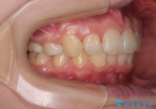 飛び出した前歯 抜歯矯正で横顔が劇的変化の治療後