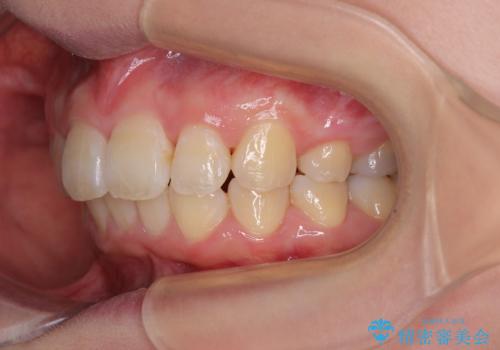 飛び出した前歯 抜歯矯正で横顔が劇的変化の治療後