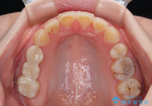 飛び出した前歯 抜歯矯正で横顔が劇的変化の治療後
