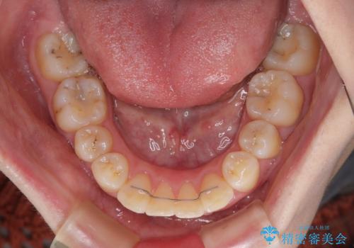 飛び出した前歯 抜歯矯正で横顔が劇的変化の治療後