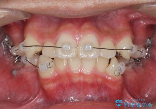 がちゃがちゃした前歯をきれいにしたいの治療前