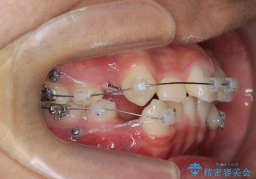 がちゃがちゃした前歯をきれいにしたいの治療前