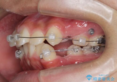 がちゃがちゃした前歯をきれいにしたいの治療前