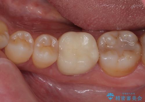 詰め物が割れたのでやり替えたい オールセラミッククラウンの症例 治療後
