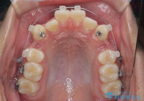がちゃがちゃした前歯をきれいにしたいの治療前