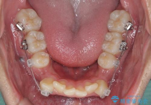 がちゃがちゃした前歯をきれいにしたいの治療前