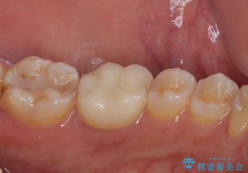 詰め物が割れたのでやり替えたい オールセラミッククラウンの治療後