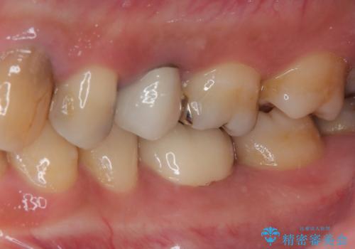 詰め物が割れたのでやり替えたい オールセラミッククラウンの治療後