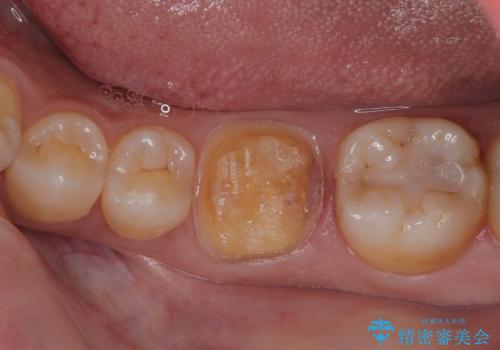 詰め物が割れたのでやり替えたい オールセラミッククラウンの治療中