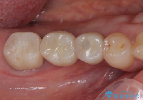 欠損を放置した奥歯 即時荷重インプラントですぐに噛めるようにの症例 治療後