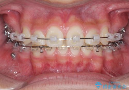 がちゃがちゃした前歯をきれいにしたいの治療中