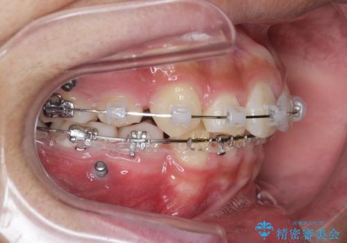 がちゃがちゃした前歯をきれいにしたいの治療中