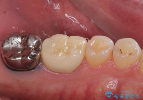 ものが噛めないほどの激痛 根管治療とセラミックのむし歯治療の治療後