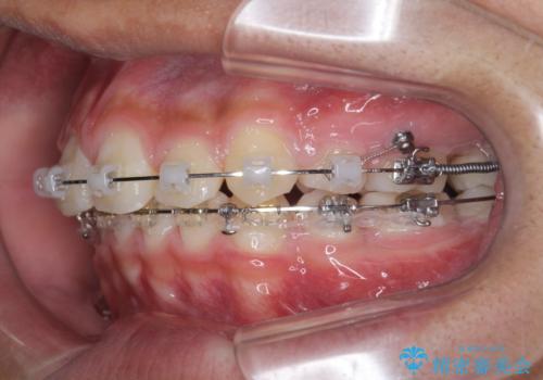 がちゃがちゃした前歯をきれいにしたいの治療中