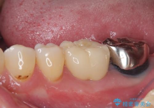 ものが噛めないほどの激痛 根管治療とセラミックのむし歯治療の治療後