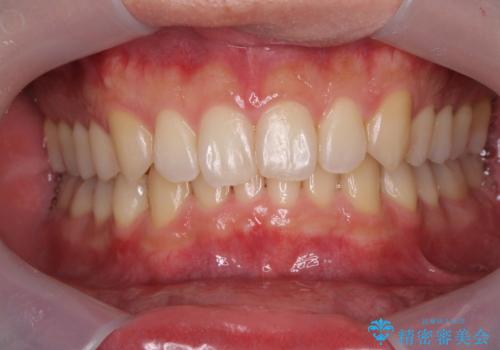 挙式前のオフィスホワイトニング!の治療前