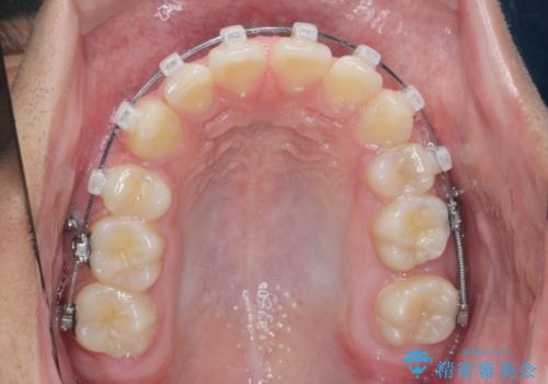 がちゃがちゃした前歯をきれいにしたいの治療中