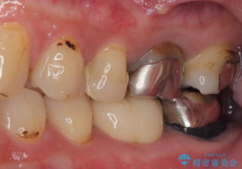 ものが噛めないほどの激痛 根管治療とセラミックのむし歯治療の治療後