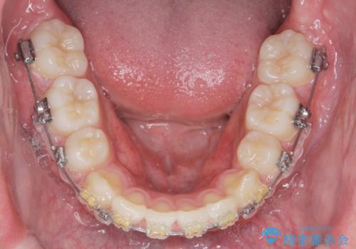 がちゃがちゃした前歯をきれいにしたいの治療中