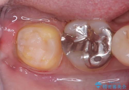 銀歯の下の虫歯|オールセラミッククラウン|歯を長持ちさせるための治療|歯の神経を守るの治療中