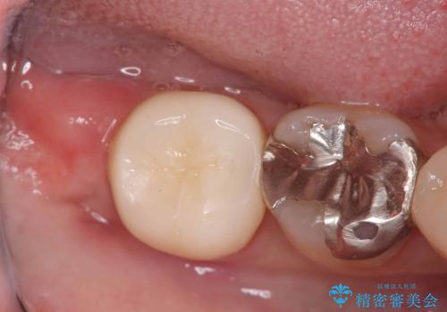銀歯の下の虫歯|オールセラミッククラウン|歯を長持ちさせるための治療|歯の神経を守るの症例 治療後
