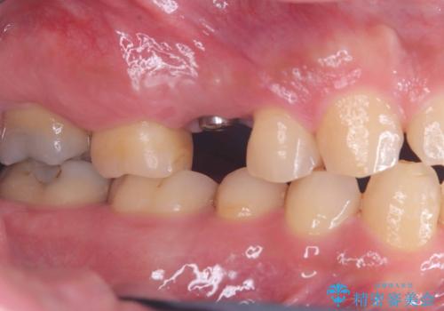 低侵襲なインプラント|痛くないインプラント|エンドペリオ病変|虫歯治療|セラッミクインレーの治療中