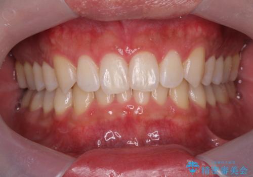 挙式前のオフィスホワイトニング!の治療後