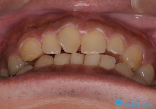 【モニター】インビザライン 前歯の捻れを治したいの治療前