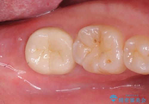 銀歯を白くしたい|オールセラミッククラウンの症例 治療後