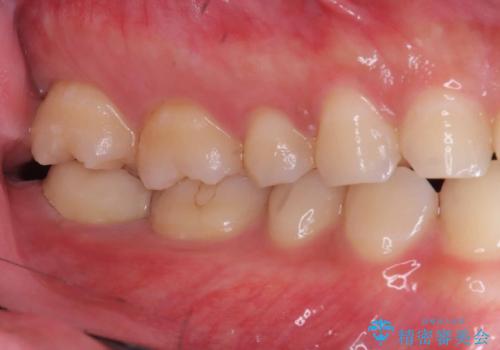 銀歯を白くしたい|オールセラミッククラウンの治療後