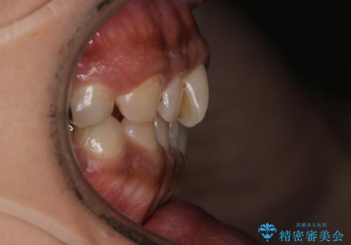 【モニター】インビザライン 前歯の捻れを治したいの治療前