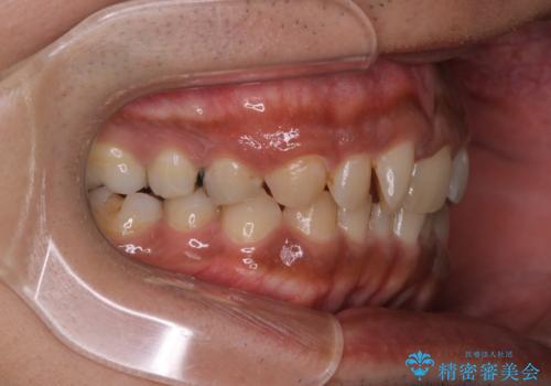 【モニター】インビザライン 前歯の捻れを治したいの治療前